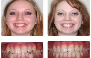 Crowding and Misaligned Teeth