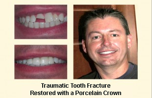 Traumatic Tooth Fracture